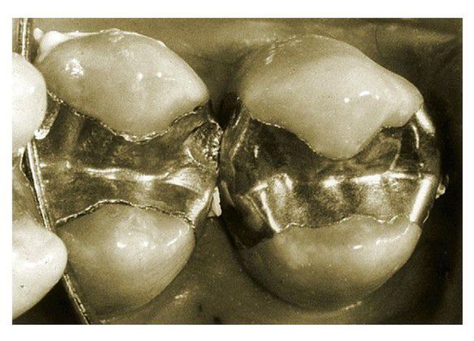 Amalgam restoration