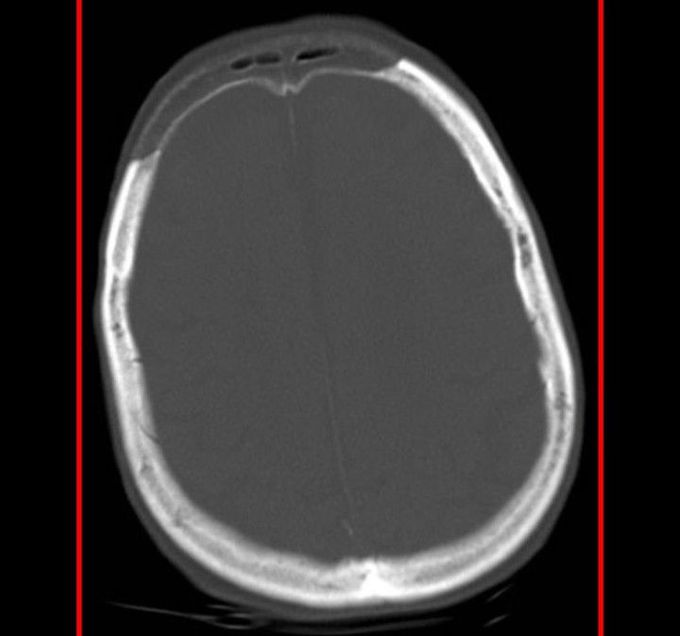 Osteoporosis circumscripta cranii