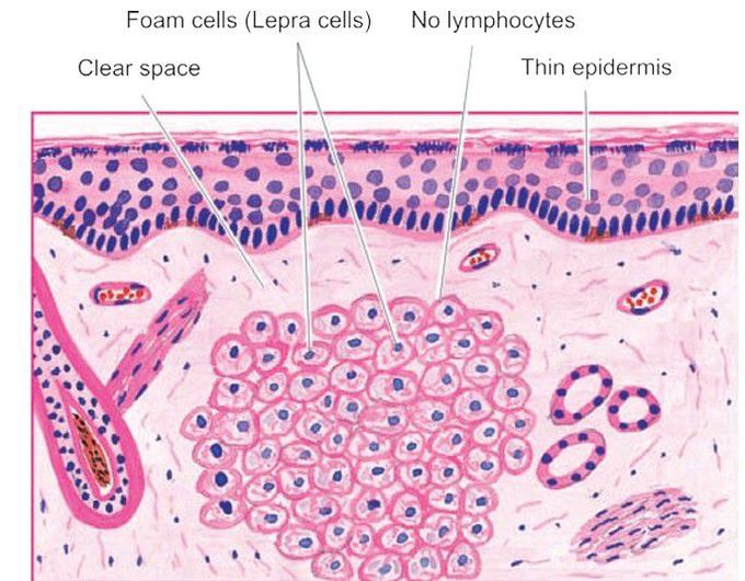 Lepromatous leprosy (LL).