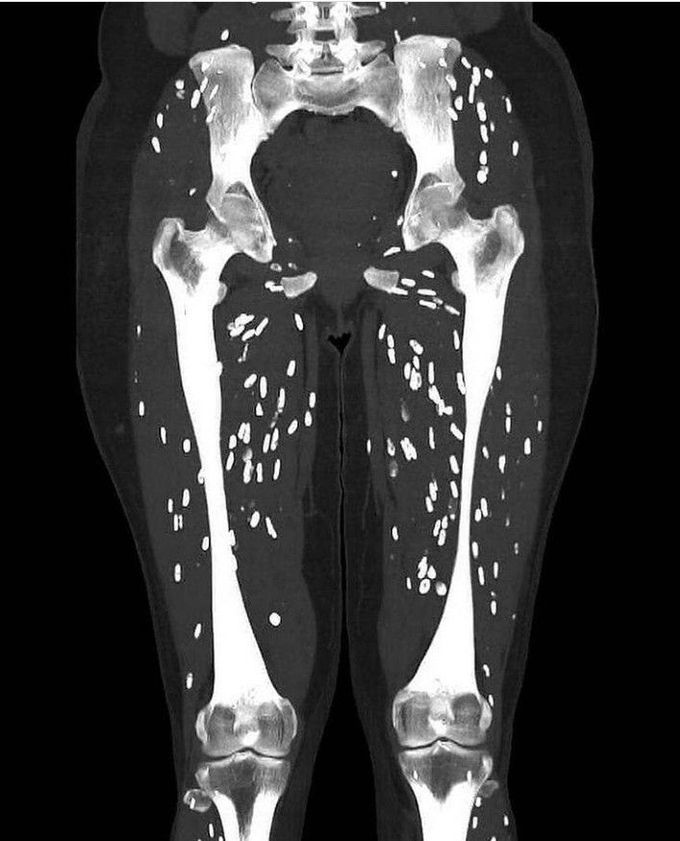 CT scan of Cysticercosis