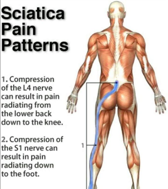Sciatic pain pattern