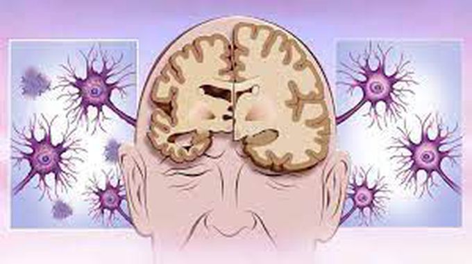 Alzheimer’s Disease Treatment