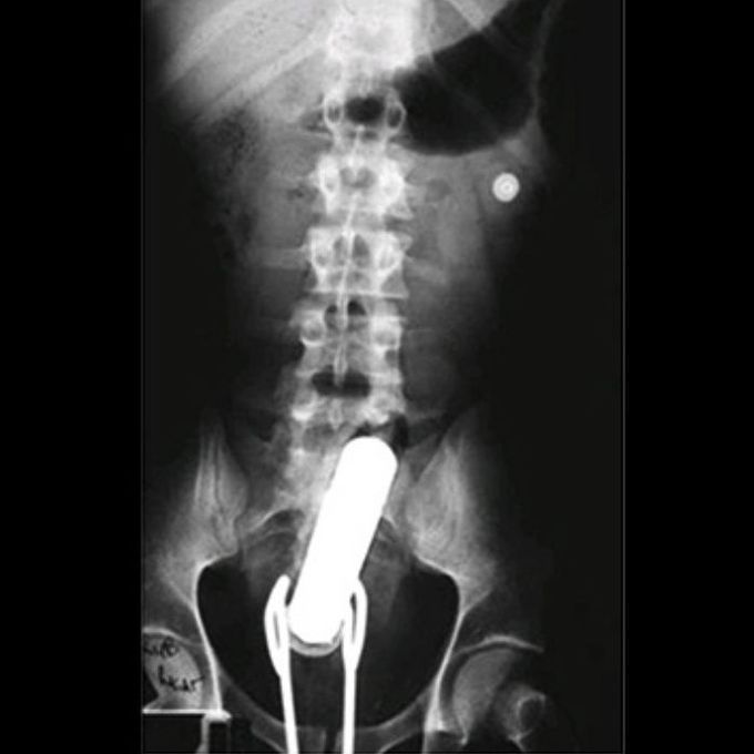 This radiograph shows a vibrator in the rectum along with a pair of salad tongs that became lodged after attempts at self-removal