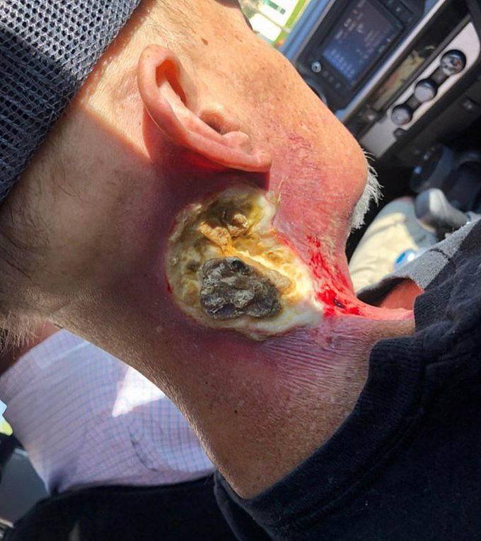 Squamous cell carcinoma