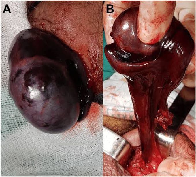 Testicular necrosis