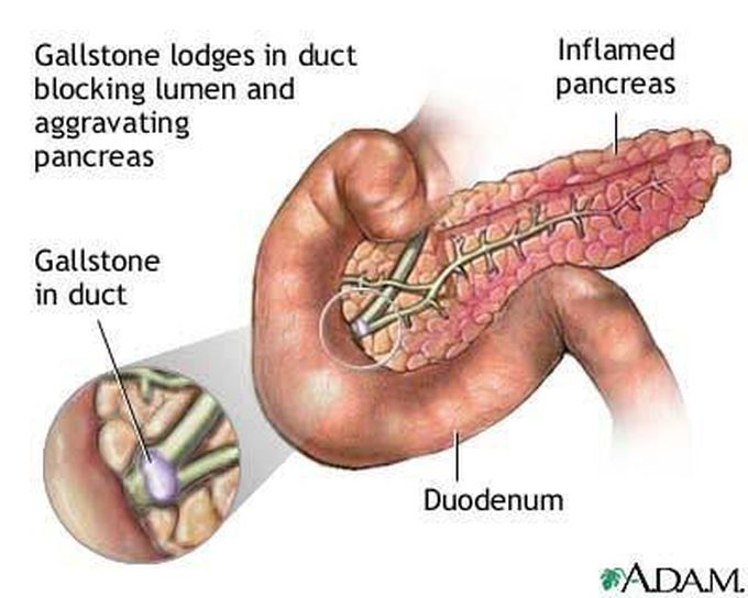 Common Bile Duct obstruction is most common cause Acute Pancreatitis and lead to epigastric pain and radiate to the back