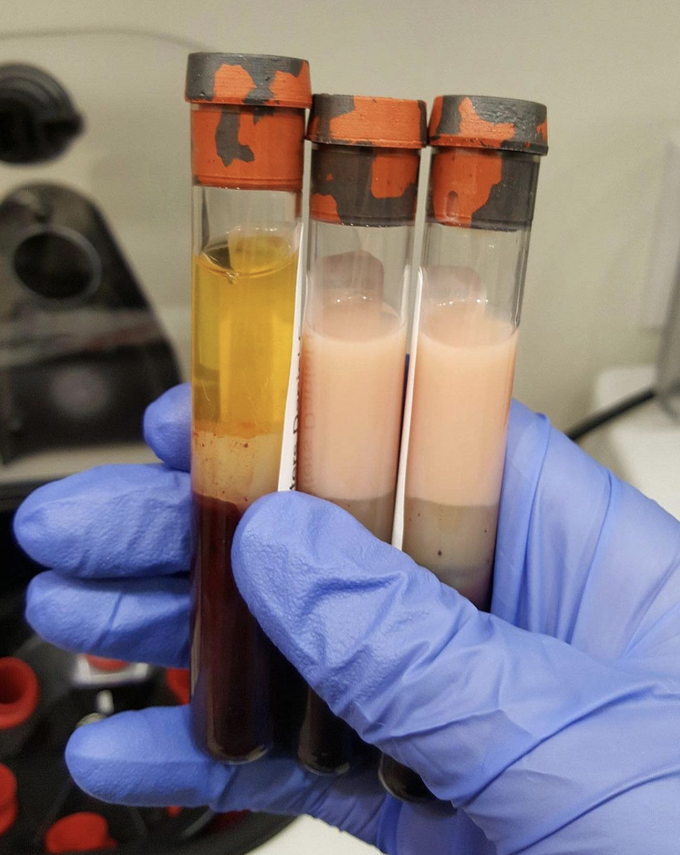 Normal plasma (left sample) and lipemic plasma (right two samples).