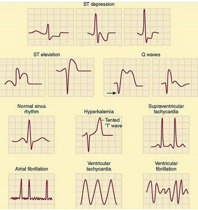 Normal vs abnormal sinus rhythm medizzy