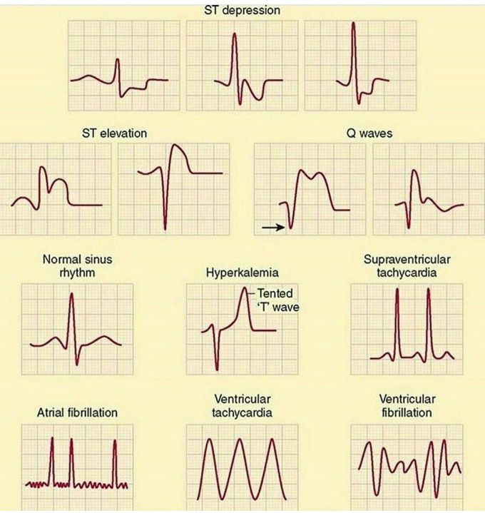 Normal Vs Abnormal Sinus Rhythm Medizzy 