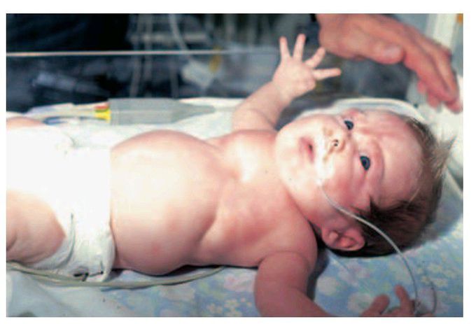 Severe upper airway obstruction