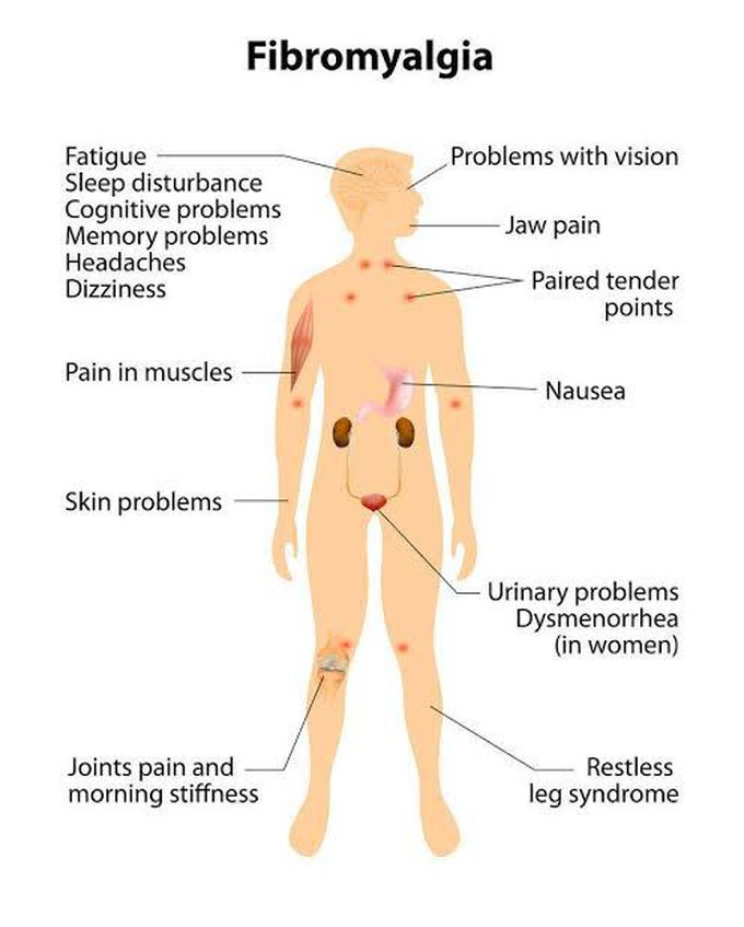 These are the symptoms of Fibromyalgia