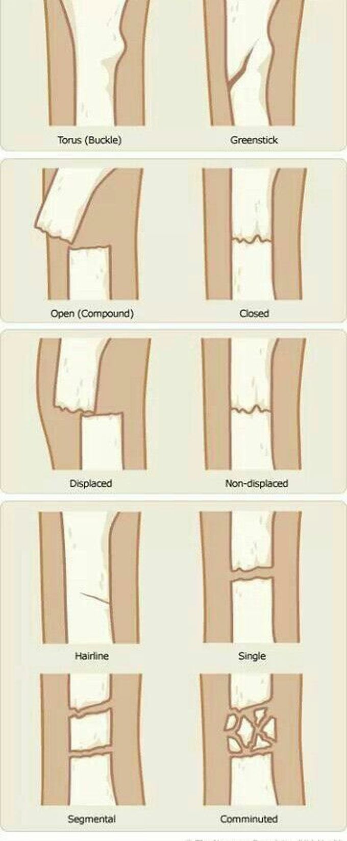 FRACTURES