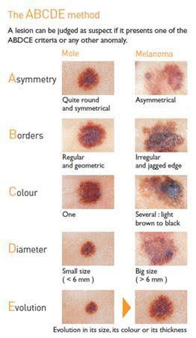 ABCD Method for Melanoma