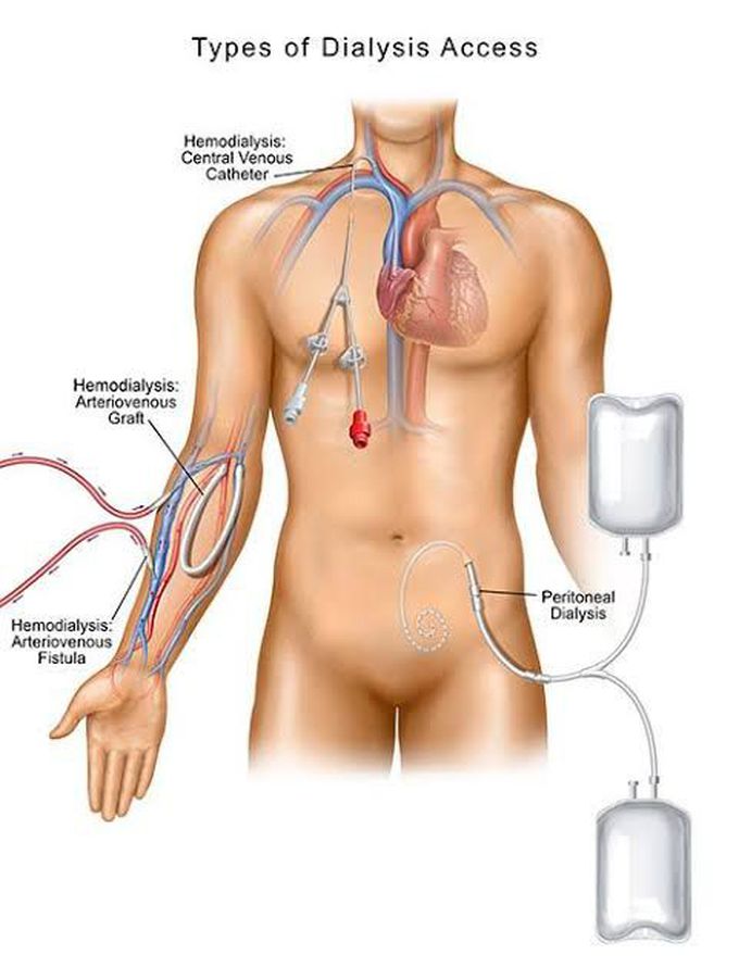 Types of Dialysis
