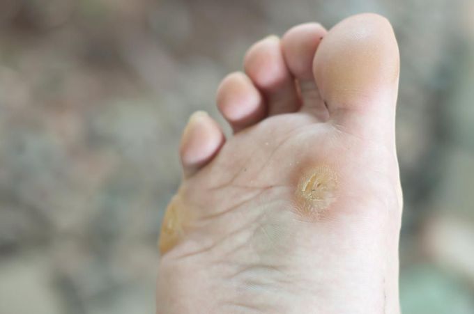 Verruca Plantaris aka Plantar Warts