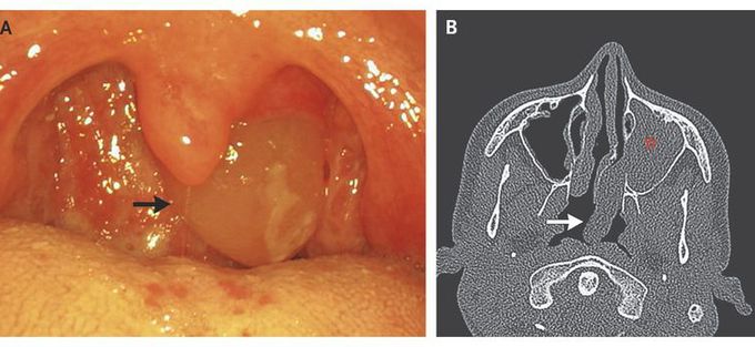 Intraoral Presentation of Antrochoanal Polyp
