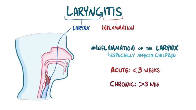 Laryngitis