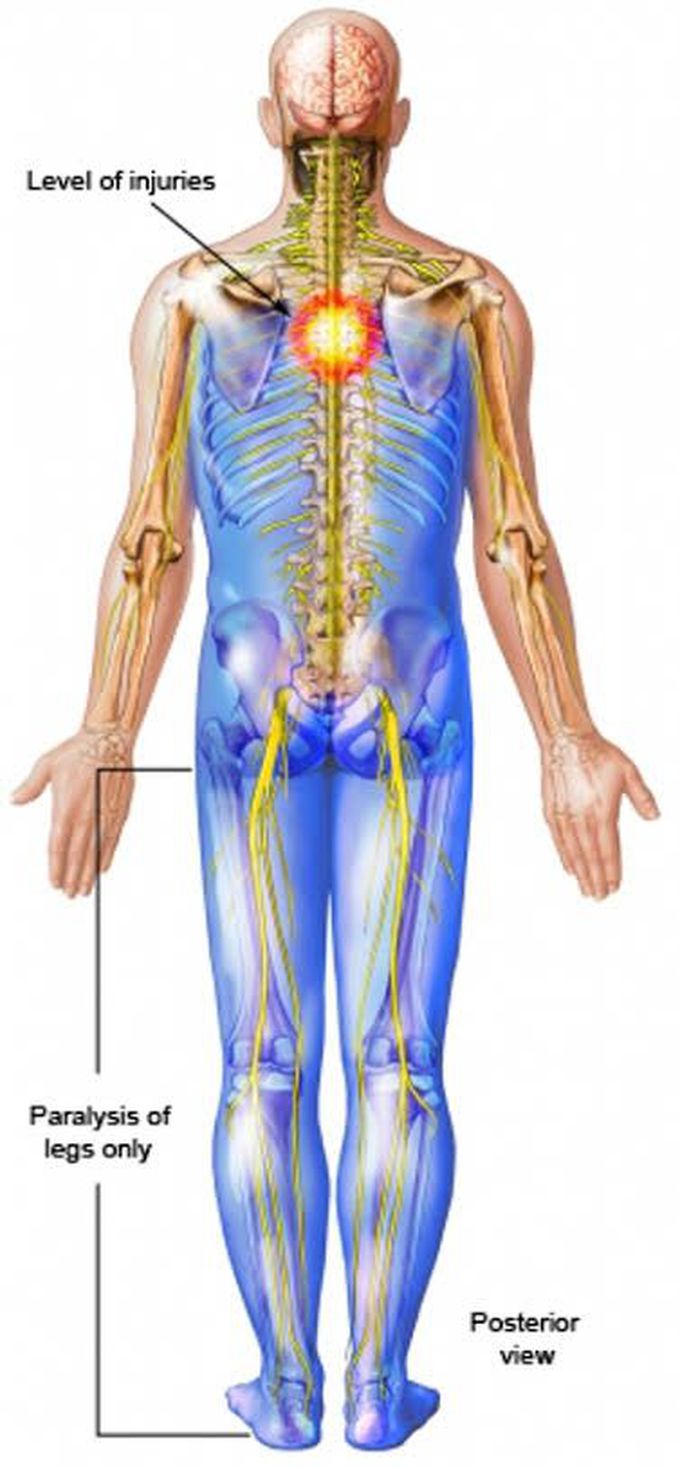 Paraplegia causes