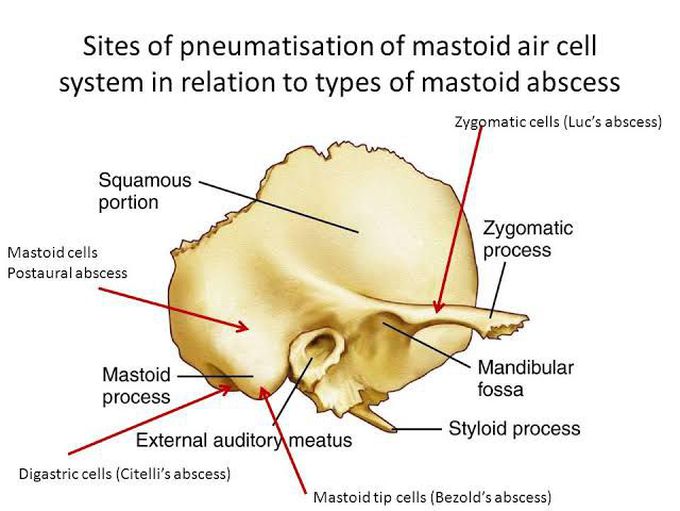 Types of mastoid abcesses