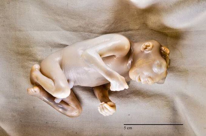 Anencephaly