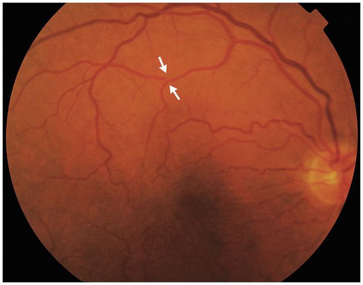 Amaurosis Fugax Caused by a Branch Retinal Artery Embolus - MEDizzy