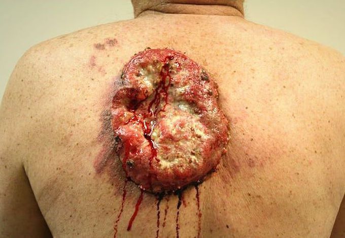 ⚠️ A case of an enormous squamous cell carcinoma growing on patient's back! 