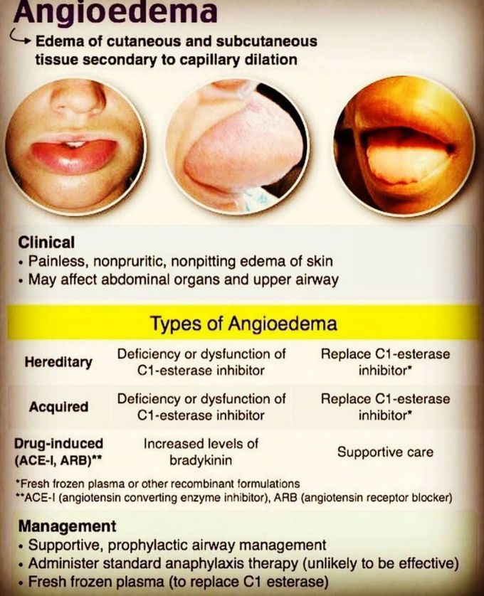 Angioedema