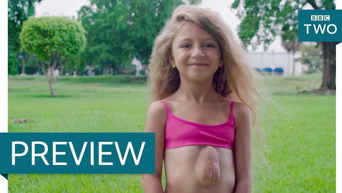 The Girl Born With Her Heart Outside Her Chest