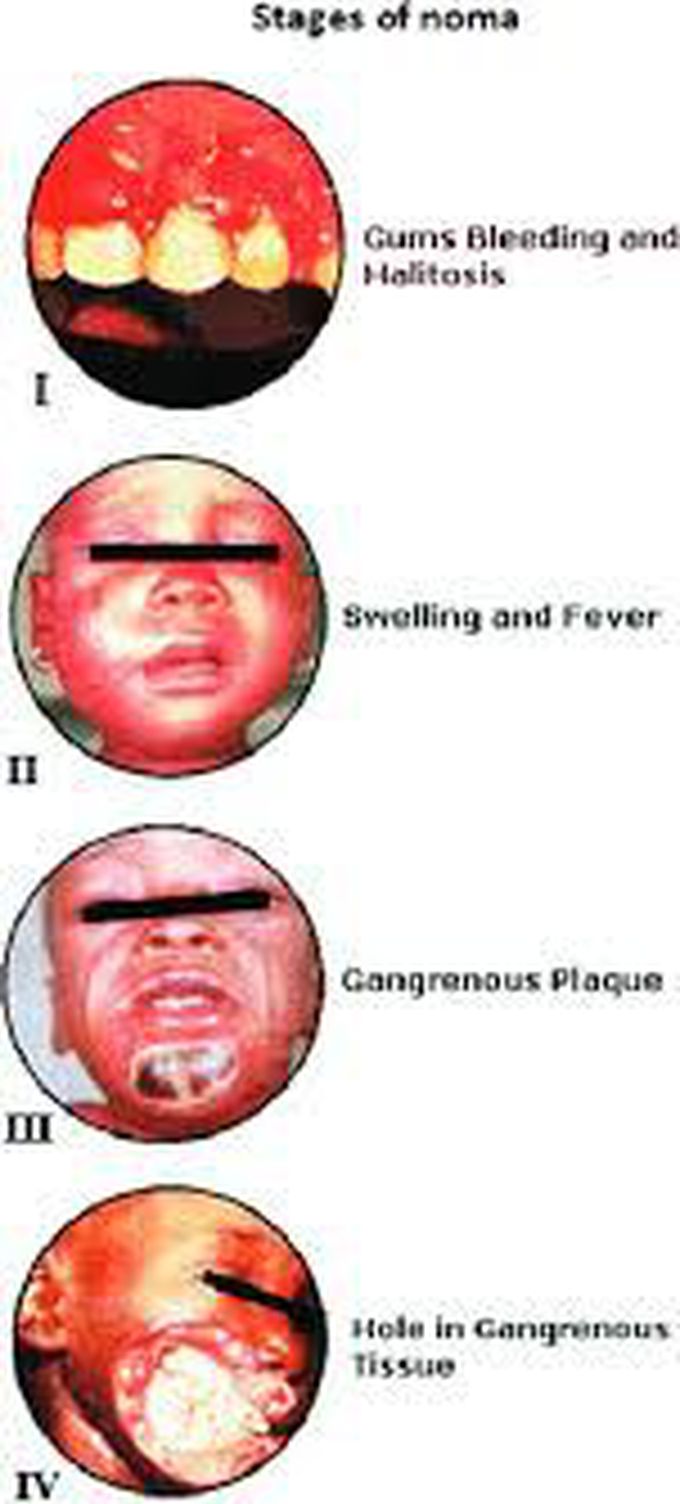 Noma disease symptoms