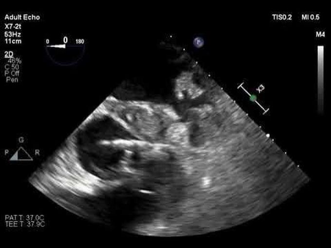 Narrowing of Coronary Arteries and Presence of Aortic Root Abscess