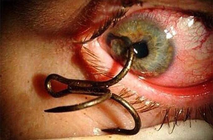 Eye injury sustained while fishing from a fishing hook! - MEDizzy