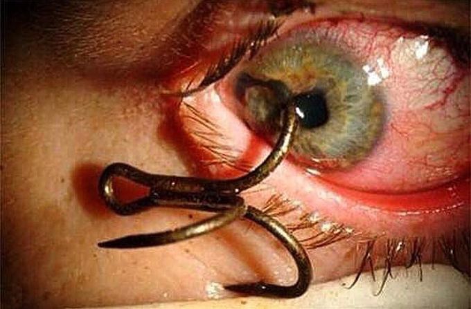 Eye injury sustained while fishing from a fishing hook!