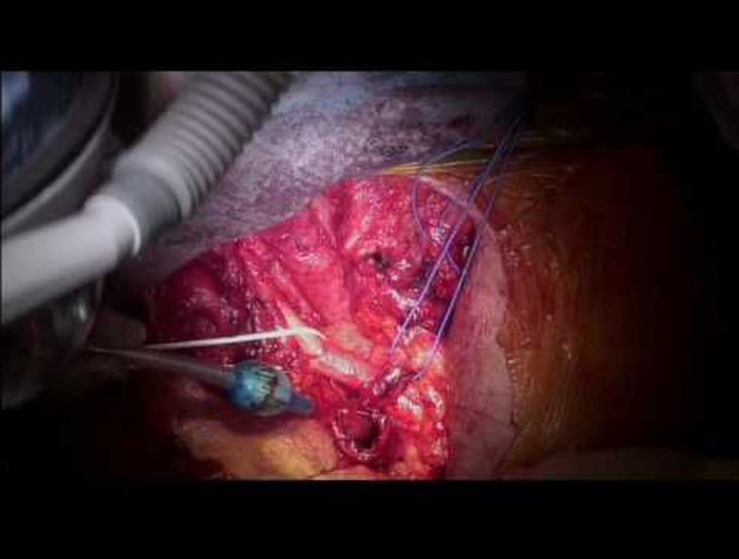 Mediastinal Tracheostomy in the Management of Recurrent Laryngeal Cancer