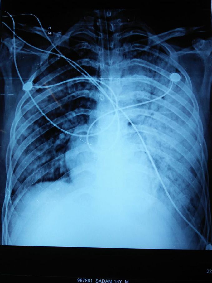 Xray of post op neurosurgery patient spo2 decreasing .pt is having brain edema and is on vent .