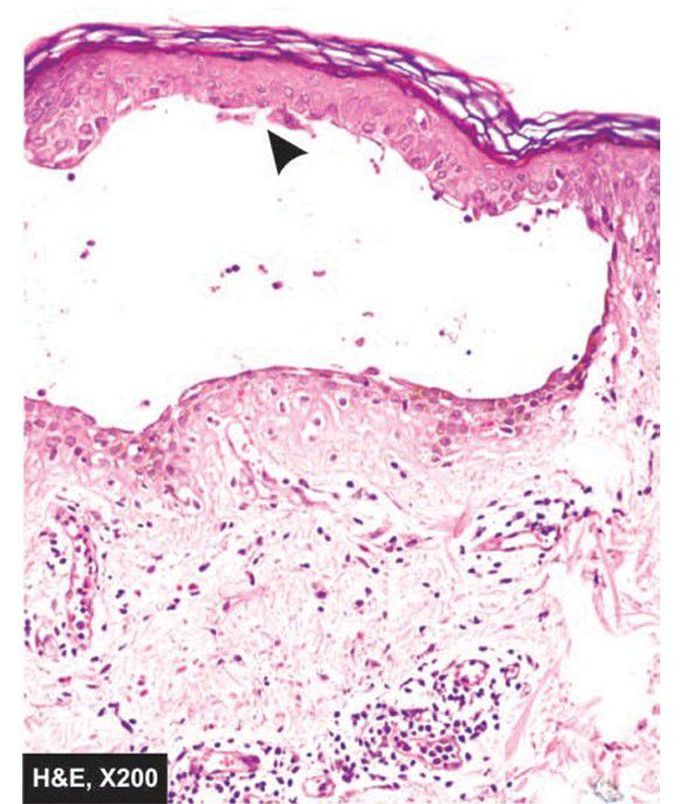 Pemphigus vulgaris.