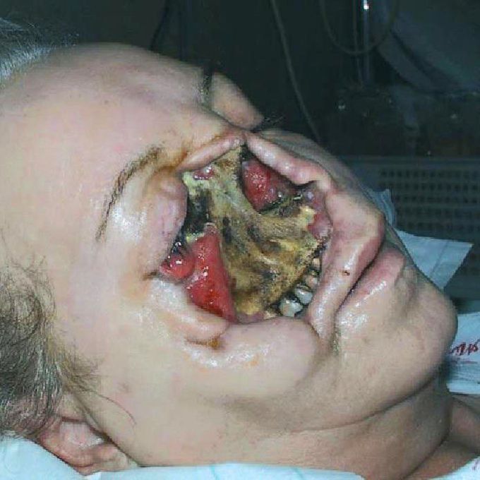 Combined Cranial Mucormycosis and Aspergillosis!! 