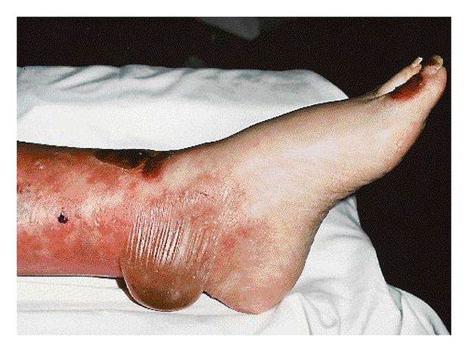 Bullous Pemphigoid