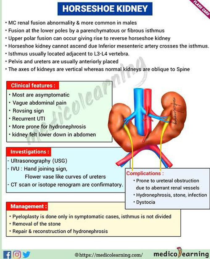 Horseshoe Kidney