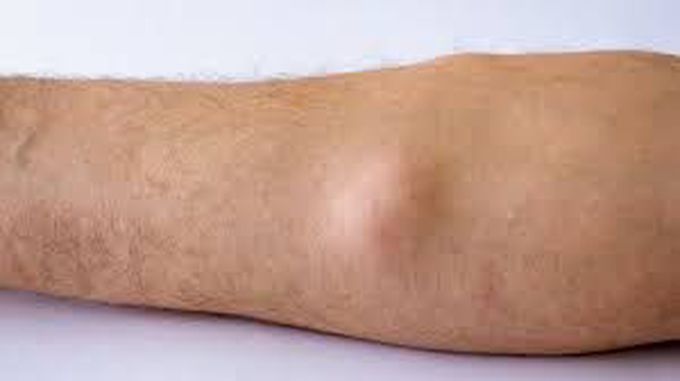 Symptoms of lipoma