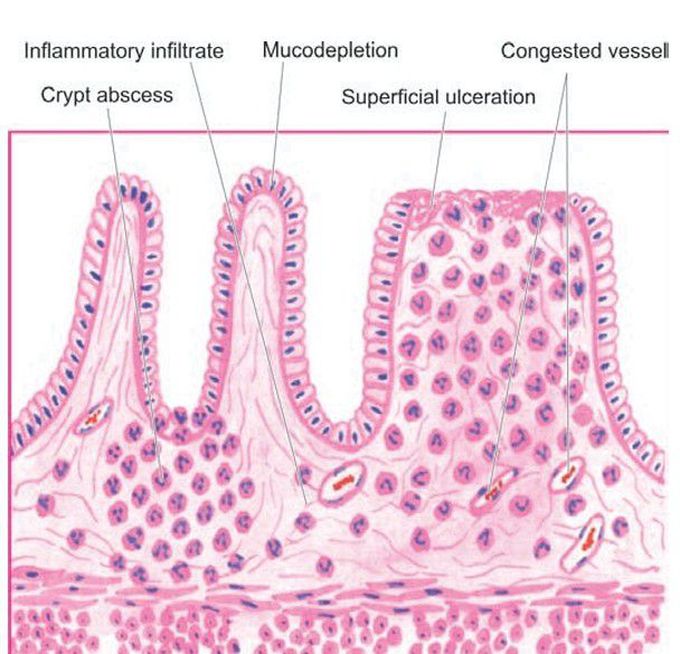 Ulcerative colitis in active phase.