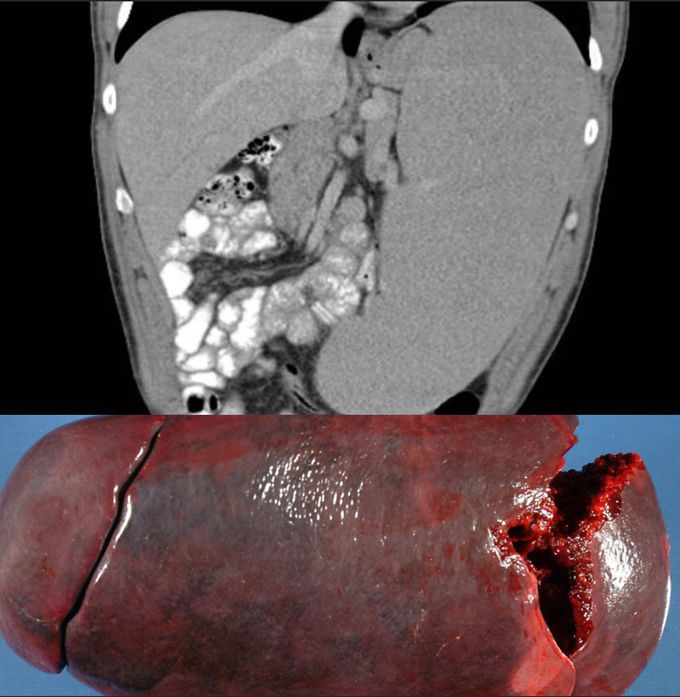 Splenomegaly