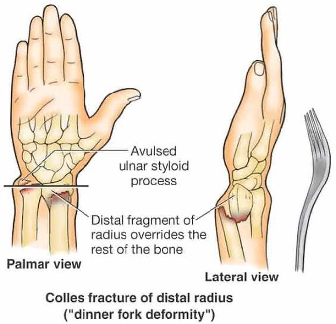 Colles Fracture Medizzy 3636