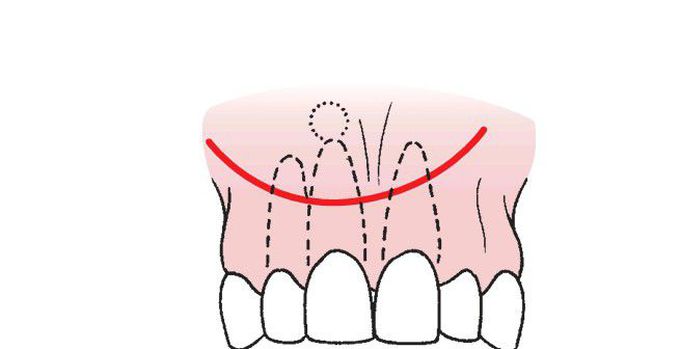 Semilunar incision