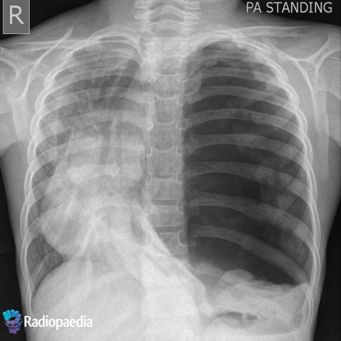Tension Pneumothorax