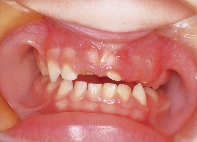 Regional odontodysplasia