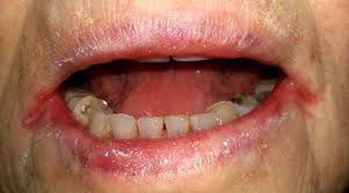 Angular Cheilitis