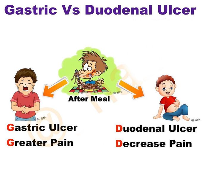 How to Differentiate the pain of  Gastric & Duodenal Ulcer ?