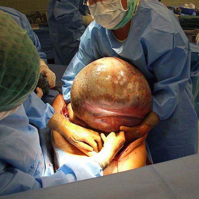 24kg tumor of the ovary