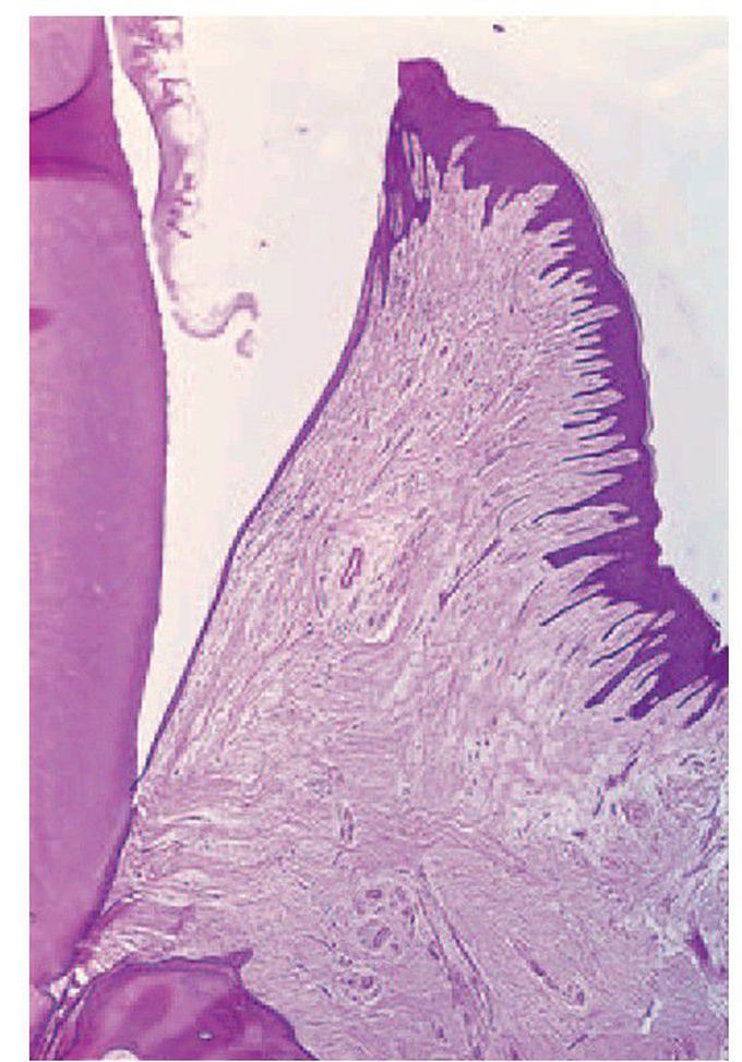 Gingival sulcus and epithelial attachment