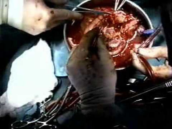 Autotransplantation for cardiac sarcoma